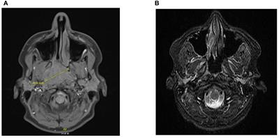 Case Report: Prolonged remission of metastatic cisplatin-refractory nasopharyngeal carcinoma with Pembrolizumab